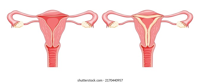 Set of Endometrial hyperplasia Female reproductive system in normal and problem uterus. Front view in a cut. Human anatomy internal organs diseases location scheme flat style icon
