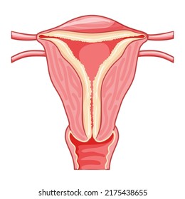 Grupo de hiperplasia endometrial Sistema reproductivo femenino útero con capa de endometrio grueso. Vista frontal en un corte. Anatomía humana órganos internos plan de localización de enfermedades icono de estilo plano