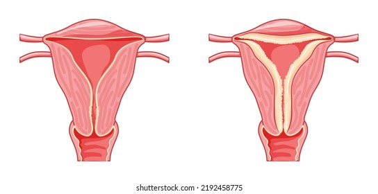 Grupo de hiperplasia endometrial Sistema reproductivo femenino en útero normal y problemático. Vista frontal en un corte. Anatomía humana órganos internos plan de localización de enfermedades icono de estilo plano