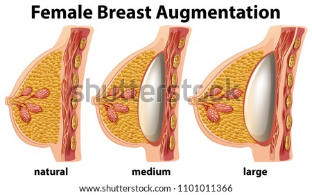 A Set of Female Breast Augmentation illustration