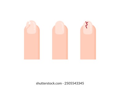 Set of fingernail icon. Broken fingernail. Healthcare, beauty, self care, manicure, treatment concept. Flat vector design isolated illustration.