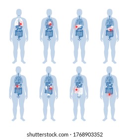 Set with flat vector isolated illustrations of pain and inflammation in obese male body. Stomach, liver, intestine, bladder, and other internal organs icon. Medical information poster or banner