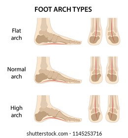 Set of foot arch types. Vector illustration