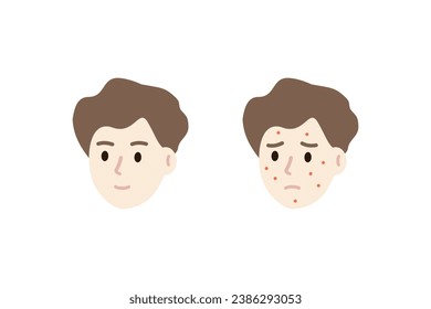 Set of happy and sad man face head with red rash pimple. Boy with skin problem. Beauty, skincare, treatment, hygiene, allergy concepts. Flat vector people character design isolated illustration.