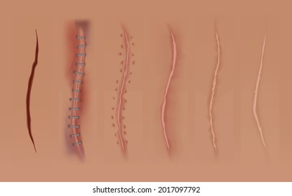 Set of healing wounds, skin scars, stitched gash and cuts. Realistic surgical sutures, stitched wounds at different healing stages isolated on human skin background