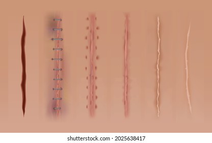 Set of healing wounds, skin scars, stitched gash and cuts. Realistic surgical sutures, stitched wounds at different healing stages. Collection of ruptures in body tissue