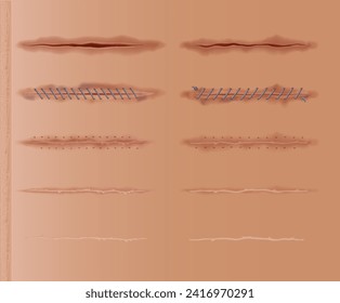 Set of healing wounds, skin scars, stitched gash and cuts. Realistic surgical sutures, stitched wounds at different healing stages isolated on human skin background