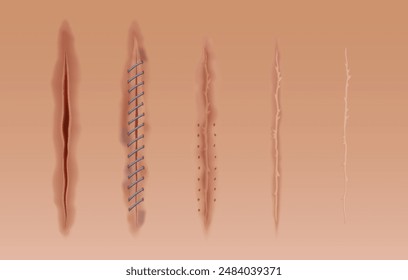 Set of healing wounds, skin scars, stitched gash and cuts. Realistic surgical sutures, stitched wounds at different healing stages isolated on human skin background