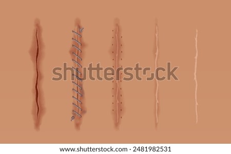 Set of healing wounds, skin scars, stitched gash and cuts. Realistic surgical sutures, stitched wounds at different healing stages isolated on human skin background