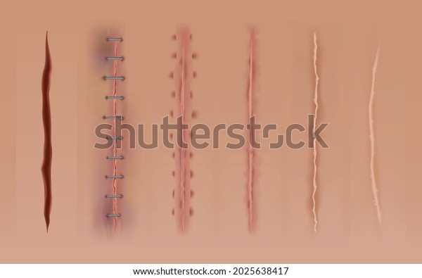 Set of healing
wounds, skin scars, stitched gash and cuts. Realistic surgical
sutures, stitched wounds at different healing stages. Collection of
ruptures in body tissue
