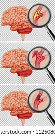 A Set of Human Brain With Stroke illustration