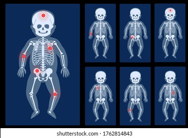 Set of human child skeleton anatomy in front on x ray view. Pain, fracture or inflammation. Vector isolated flat illustration of skull and bones in baby body. Medical, educational banner.