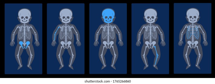 Set of human child skeleton anatomy in front on x ray view. Vector isolated flat illustration of skull and bones in baby body. Medical, educational or science banner on blue background.