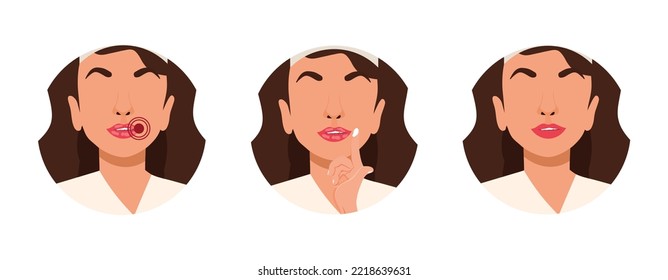 A set of icons with girls applying cream to the corner of their lips. Inflammation. Stomatitis. Vector Stock illustration. White background. isolated