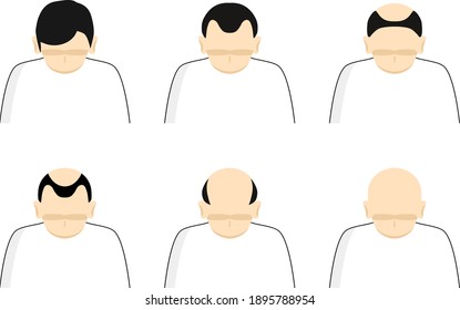 set illustration of Androgenetic alopecia   man's head