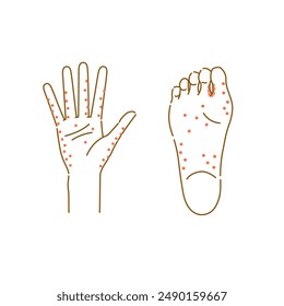 A set of illustrations of areas where sweat rash often occurs (hands and soles of the feet)