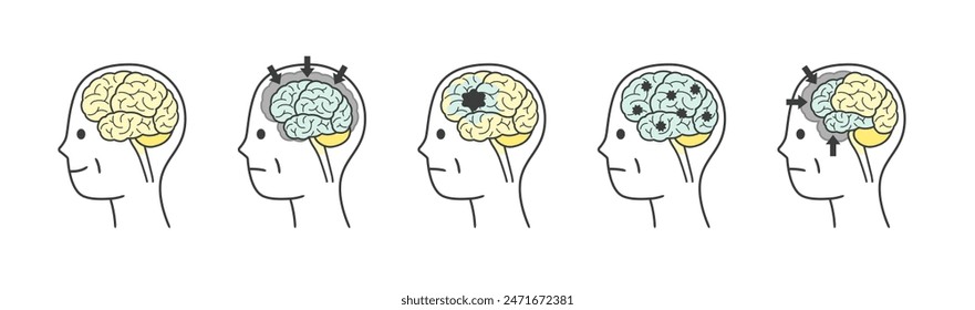 A set of illustrations of parts of the brain that are damaged by dementia in the elderly