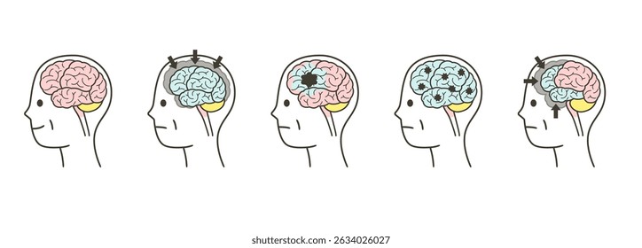 A set of illustrations of parts of the brain and their names that are damaged by dementia in the elderly