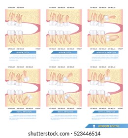 set of impacted wisdom tooth cause dental problems