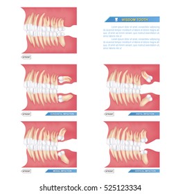 set of impacted wisdom tooth cause dental problems