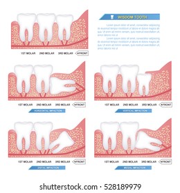 set of impacted wisdom tooth and dental problems