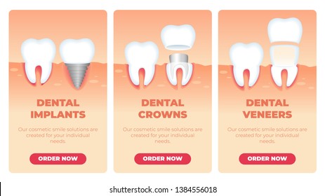 Set Inscription Dental Implants Crowns Veneers. Our Cosmetic Smile Solutions are Created for your Individual Needs. Vector Illustration Landing Page. Healthy Tooth and Restored or Improved Tooth.