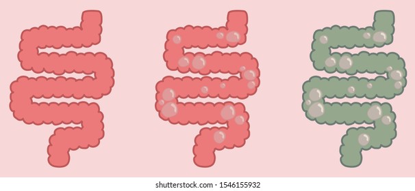 A set of intestines - healthy, bloated with gas, sick with gas. Vector