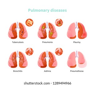 Chronic obstructive pulmonary disease Images, Stock Photos & Vectors ...