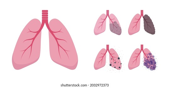 Set of lungs illustrations. Healthy and sick lungs. Human respiratory system icons