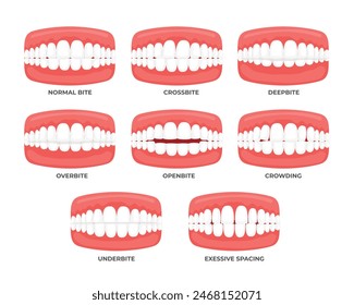 Set of Malocclusion types set with side view of normal, misalignment and incorrect relation between human teeth of upper and lower jaw vector illustration, Teeth trouble, vector illustration.