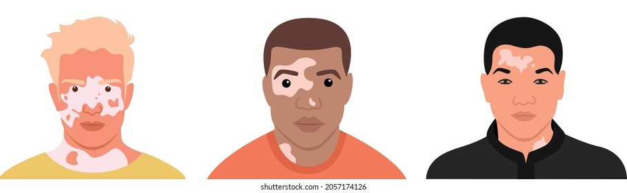 A set of men with Vitiligo of different nationalities and appearances. Flat vector illustration. Skin disease, body positive, self-acceptance.