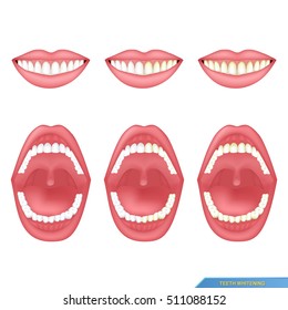 set of mouth and tooth whitening
