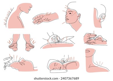 Set of people undergoing acupuncture on white background