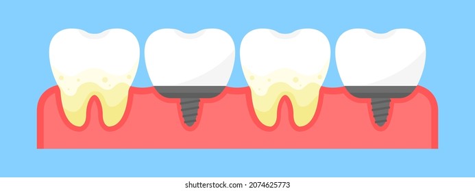 A set of plaque teeth and dental implants. Dentistry. Teeth in gums. Dental treatment in a dental clinic. Flat style. Vector illustration