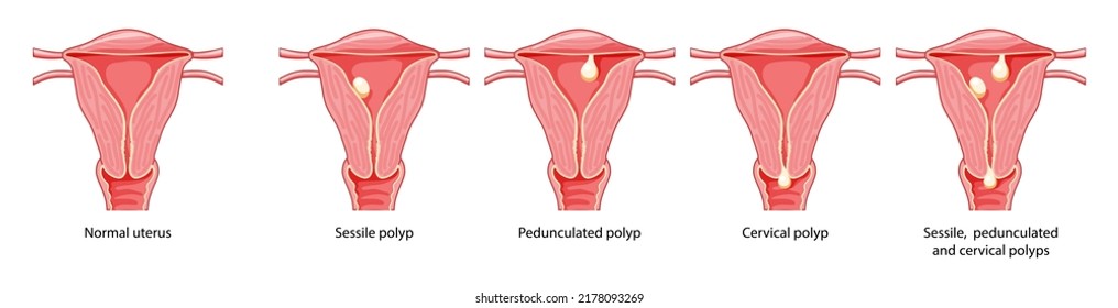 Conjunto de pólipos en el sistema reproductivo femenino del útero en las enfermedades de corte transversal y normal. Vista frontal en un corte. Anatomía humana esquema de ubicación de órganos internos, cervix, icono de estilo plano ovario