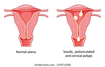 Set of Polyps in the uterus Female reproductive system in cross sections diseases and normal. Front view in a cut. Human anatomy internal organs location scheme, cervix, ovary flat style icon