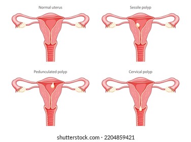 Set of Polyps in the uterus Female reproductive system in cross sections diseases and normal. Front view in a cut. Human anatomy internal organs location scheme, cervix, ovary flat style icon