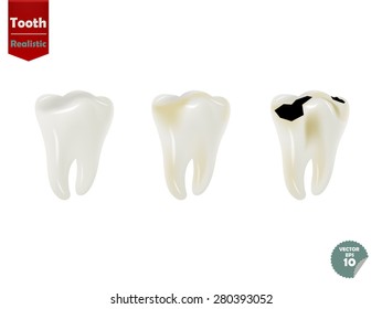 set of realistic tooth including healthy tooth and decayed tooth