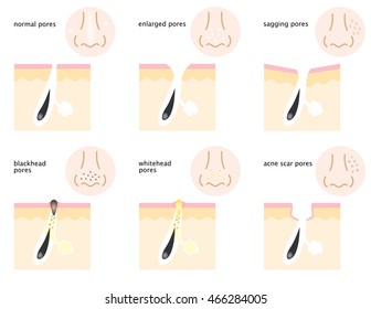 set of skin pores on nose, normal, sagging, open, blackhead, whitehead, and acne scar 