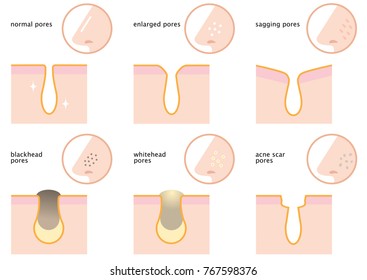 set of skin pores on nose: normal, sagging, enlarged, blackhead, whitehead  and acne scar