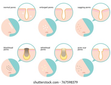 set of skin pores on nose: normal, sagging, enlarged, blackhead, whitehead  and acne scar