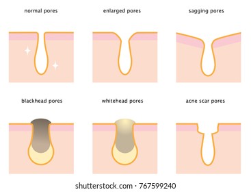 set of skin pores on nose: normal, sagging, enlarged, blackhead, whitehead  and acne scar