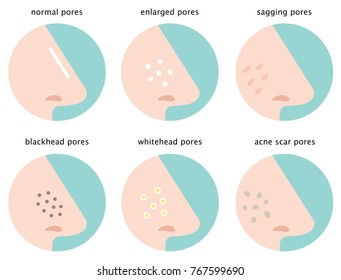 set of skin pores on nose: normal, sagging, enlarged, blackhead, whitehead  and acne scar