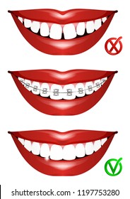 Set of smiles. Curved teeth, teeth in braces and even beautiful teeth. Illustration of orthodontic treatment. Vector illustration.