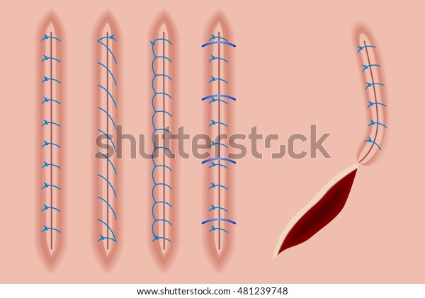 Set Surgical Stitches On Skin Sutures Stock Vector (Royalty Free) 481239748