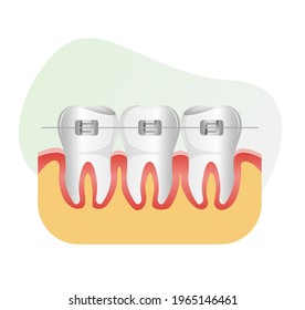 Set of Teeth with Dental Braces - stock illustration  as EPS 10 File