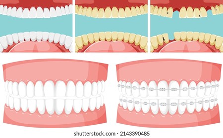 Set Of Teeth Inside Human Mouth With Human Teeth Model Illustration