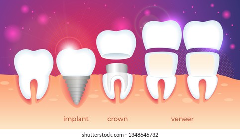 Set of Teeth Problem. Diseased Tooth in Human Gum. Visualization of Different Ways Orthodontic Restoration. Implant, Crown, Dental Veneer on Gradient Background with Sparkles. Flat Vector Illustration