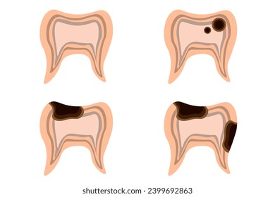 Set of Teeth in trendy cut out paper style isolated white. Collection 3d healthy and diseased teeth. Dental decay. Vector illustration can used web icon, social media poster for dental clinic.