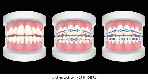 Set of tooth model with metal wire dental braces